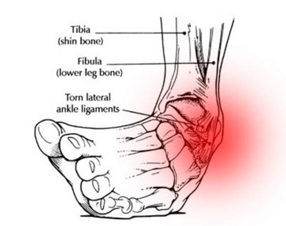 How Do I Treat an Ankle Sprain?