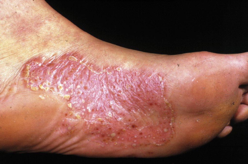 I have an itchy foot rash: is it tinea or athlete's foot?
