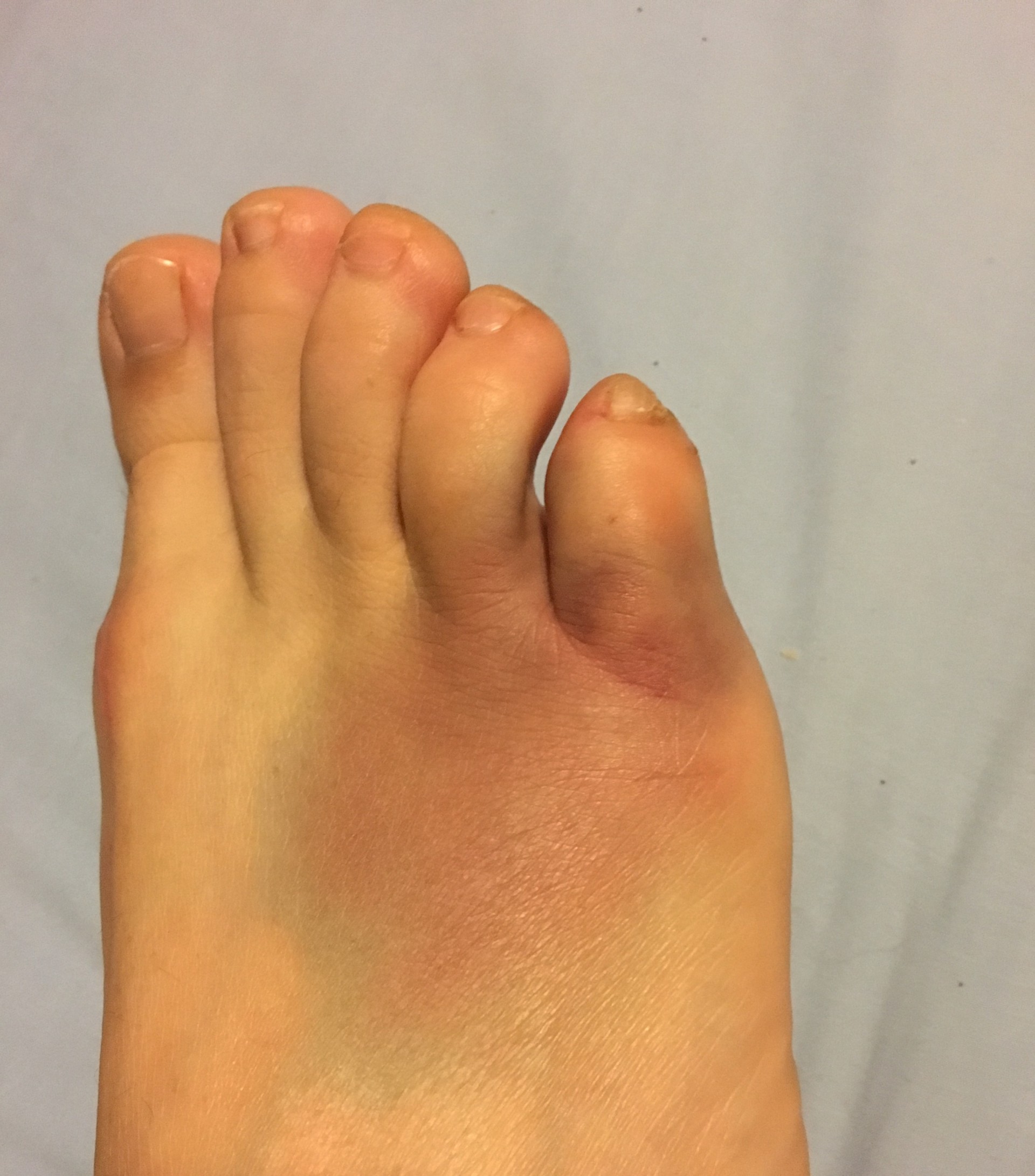 All 92+ Images pictures of a broken foot Latest