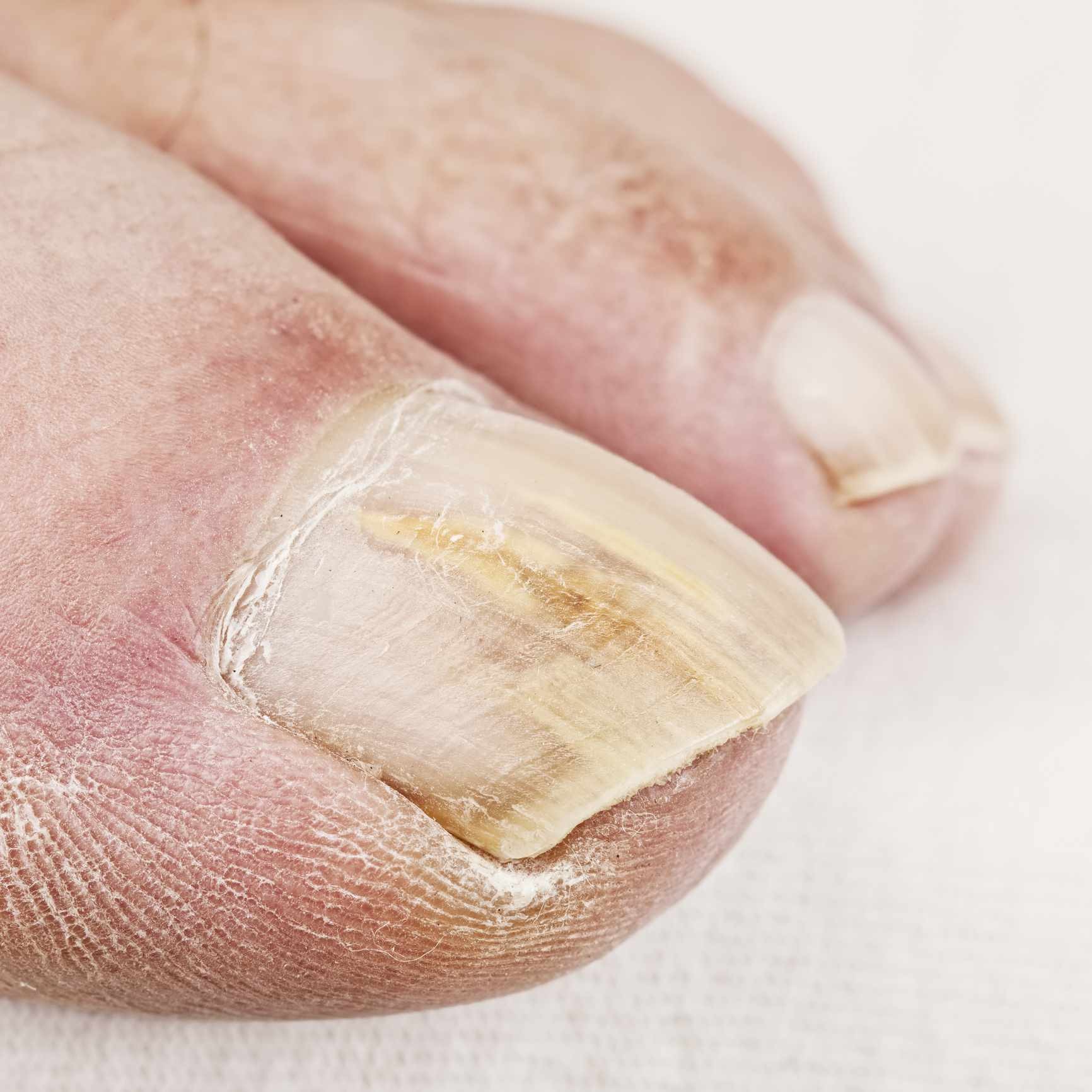 What is Distal subungual onychomycosis (DSO) nail fungus and how is it  treated? - Dermatology Physicians of Connecticut
