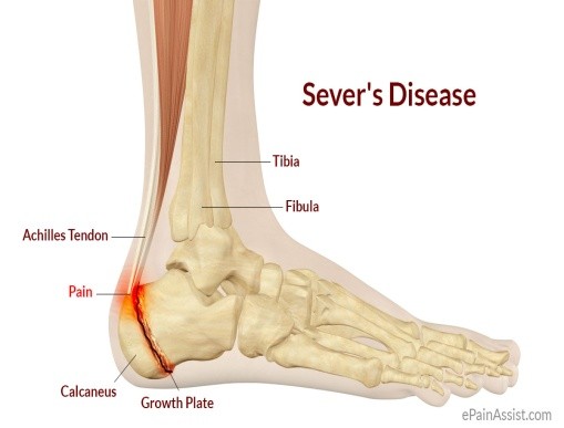Causes For Heel Pain - Get Great Clinic Treatment