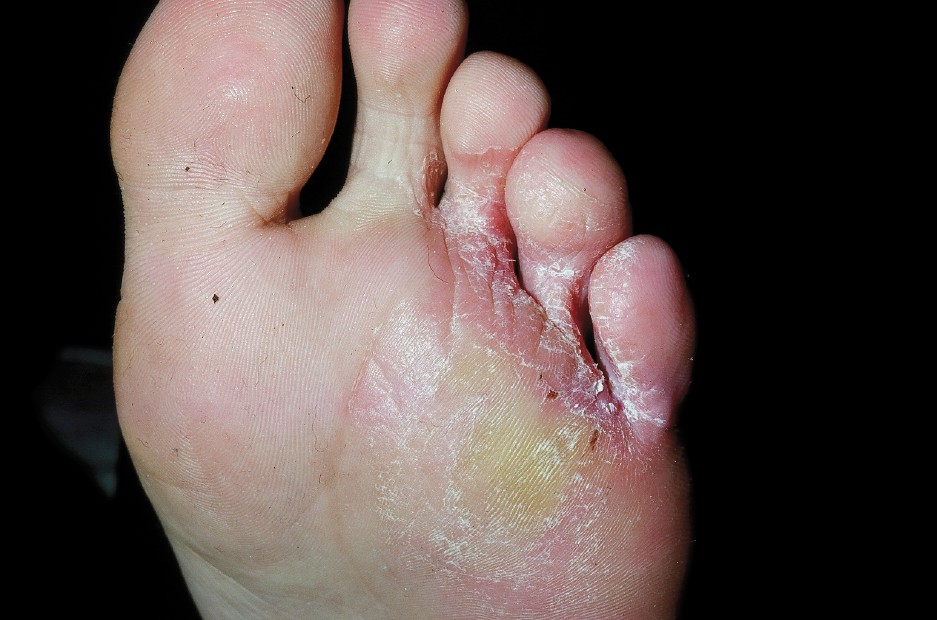 I Have An Itchy Foot Rash Is It Tinea Or Athlete S Foot